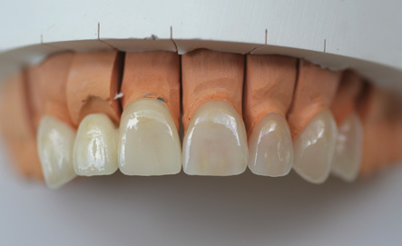 Versorgung des Zahnes mit Frontal-Zahnkronen und Veneers Versorgung des Zahnes mit Frontal-Zahnkronen und Veneers