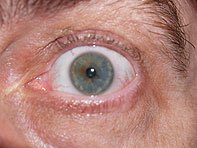 Augendiagnose-2 augendiagnose